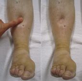 Edema by Dr. James Heilman (CC 3.0)